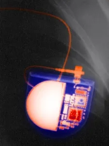 Medical Imaging Technology Prints: Pacemaker