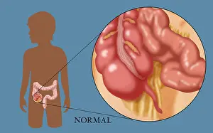 Human Digestive System Illustration Prints: Normal Appendix