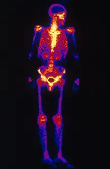 Medical Imaging Techniques Prints: Normal Bone Scan