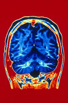 Magnetic Resonance Imaging (MRI) Prints: Normal MRI of Brain