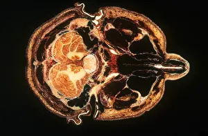 Human Brain Anatomy Prints: Slice of Human Brain, gross specimen