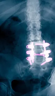 Human Vertebral Column Prints: Spinal Fusion