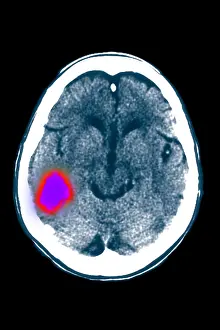 Computed Tomography Scans Prints: Temporal lobe stroke
